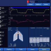 This patient had been completely passive through his stay after a devastating neurologic injury. At some point, he was noted to be triggering the ventilator 24 times per min, developing a severe respiratory alkalosis. The diagnosis here is evident from waveform inspection. The sawtooth appearance of both waveforms is generated by the reverberation of gas flow along fluid that accumulated in the circuit. These artefactual swings in flow are misinterpreted by the ventilator as patient-initiated inspiratory effort, leading to trigger events. False triggering due to reverberation of fluid in the ventilator circuit