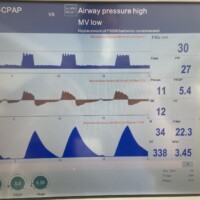 Ineffective or failed trigger in patient with suspected COPD on Volume Support