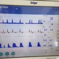 Early Cycling in Pressure Support