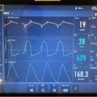 Work Shifting on PRVC (same as APV)