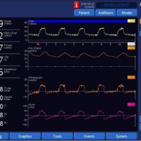 False Trigger Confirmed by Esophageal Pressure Monitor