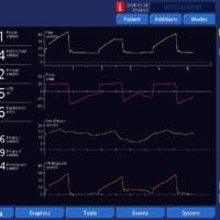Failed Trigger in Patient with Esophageal Pressure Monitor
