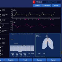 Flow Dyssynchrony/Work Shifting in VC Descending Ramp Flow with Troubleshooting