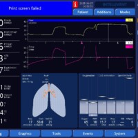 Plateau Greater Than Peak Pressure: A Sign of Patient Inspiratory Effort