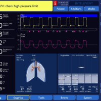 Effects of Kink in Endotracheal Tube