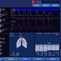 Effects of Kink in Endotracheal Tube